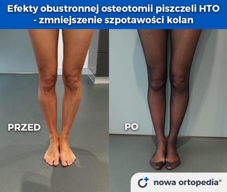 osteotomia HTO efekty